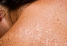 Un nuevo algoritmo es capaz de diagnosticar cáncer de piel con la misma eficacia que un dermatólogo