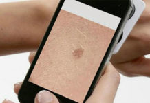 Los celulares inteligentes podrían mejorar la detección del cáncer de piel en los países en desarrollo