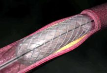 En Argentina ya se realizan cinco angioplastias por hora.