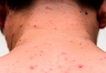 El caso del turista ruso con sarampión en Buenos Aires: viajes por Sudamérica, baja cobertura de vacunación y desinformación.