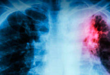 La tuberculosis resiste desde la prehistoria y se cobra 700 vidas al año en Argentina.