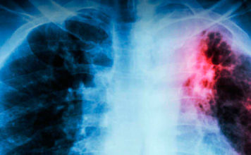 La tuberculosis resiste desde la prehistoria y se cobra 700 vidas al año en Argentina.