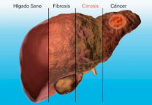 Enfermedades hepáticas: las sufren 2 de cada 5 personas, pero con frecuencia no lo saben