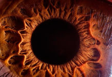 Glaucoma. Por primera vez, practicaron en el país una cirugía mínimamente invasiva.