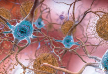 La aprobación de aducanumab, la gran oportunidad para el alzhéimer en el mundo real