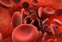 Crecen los casos de tromboembolismo vascular en jóvenes sin riesgos previos