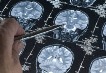 Descubren el mecanismo de avance del Alzheimer en el cerebro