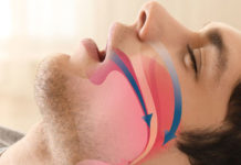 Más de 1.300 millones de personas sufren apneas de sueño y la cifra va en aumento