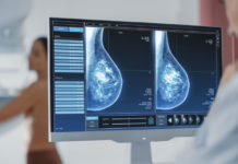 Un estudio científico confirmó que un fármaco reduce en un 76% un tipo de cáncer de mama