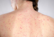 Ante la aparición de un caso de sarampión el Garrahan acentúa la importancia de vacunar