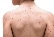 Viruela del mono: cómo se transmite, cuáles son los síntomas y qué hacer para evitar contagiarte