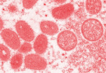 Salud informa que el resultado de la muestra PCR tomada por ANLIS Malbrán al primer caso sospechoso de viruela símica dio positivo