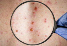 Viruela símica: Confirman el tercer caso en el país, el primero sin antecedentes de viaje