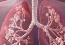 Día Mundial de la Fibrosis Quística: ¿cómo se presenta la enfermedad?