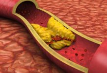 ¿Conocías estos factores de riesgo de enfermedades cardiacas?